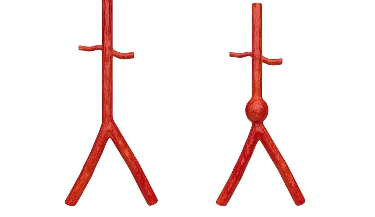 Abdominal & Thoracic Aortic Aneurysm's
