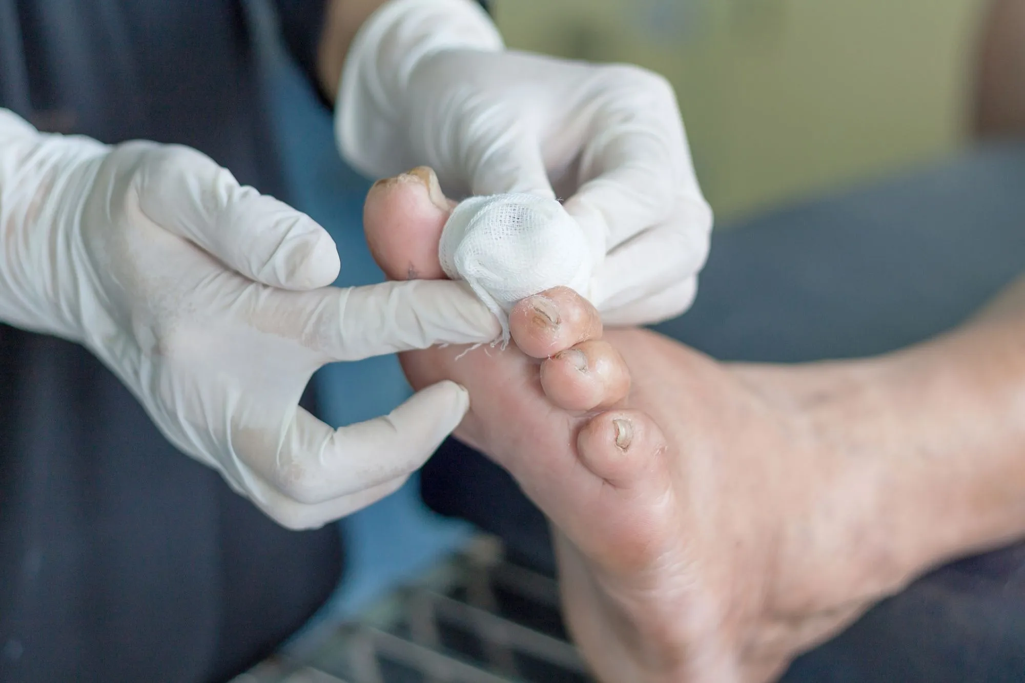 Venous Ulcers