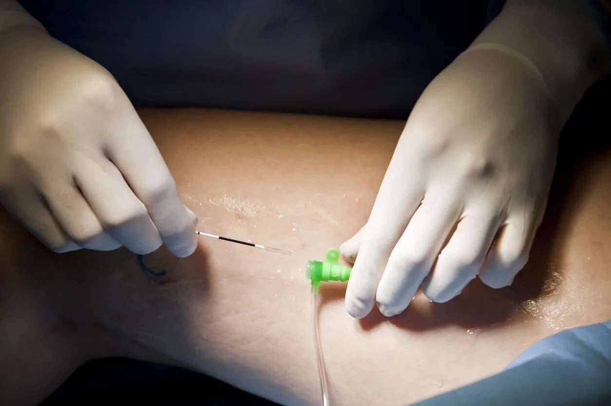 Radiofrequency Ablation Therapy for Varicose Veins