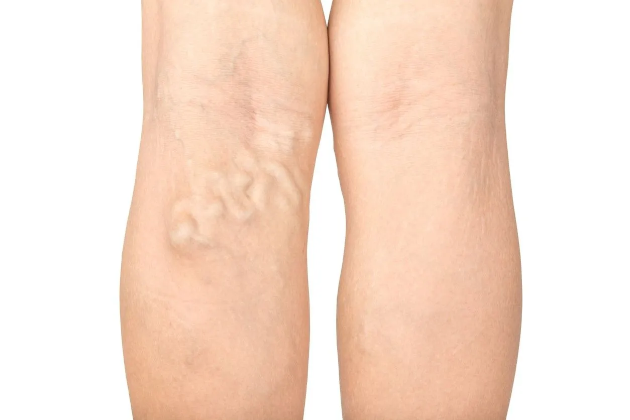 Varicose Vein Surgery