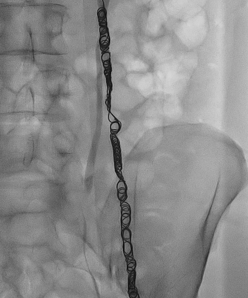 Varicocele Embolization